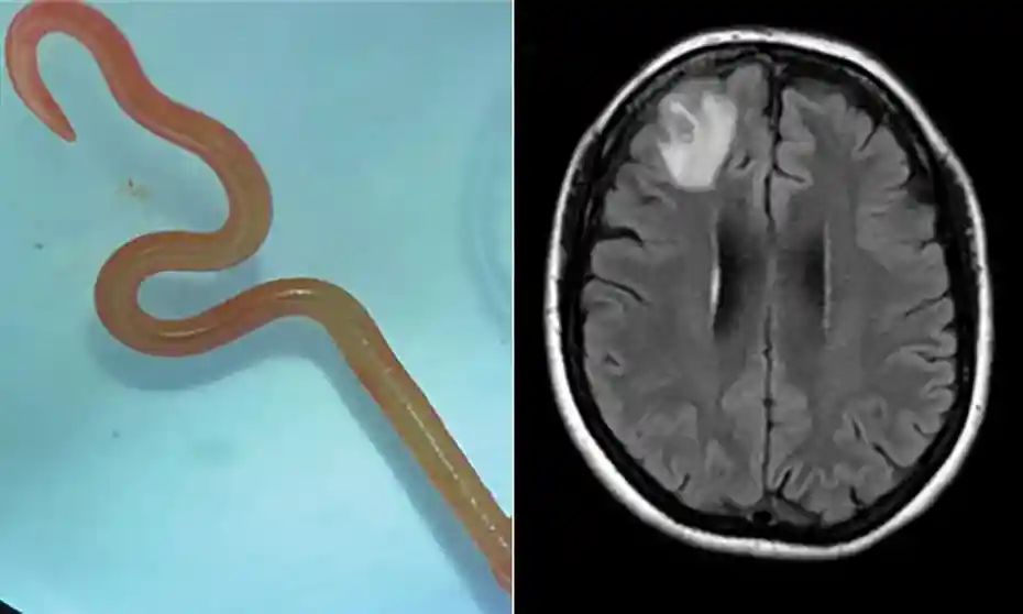 In a first-ever finding, a living worm was found in an Australian woman’s brain.